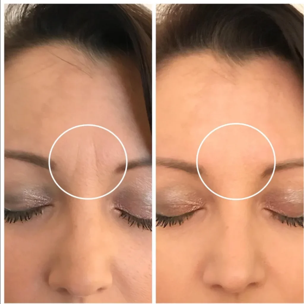 Treating Frown Lines while maintaining your “natural expression” | The subtle approach