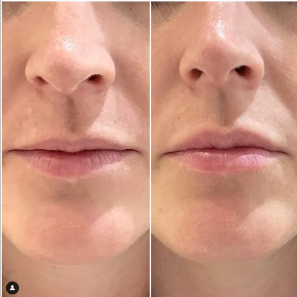 Lip Fillers Pricing image